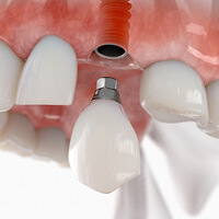 Up-close view of dental implant parts