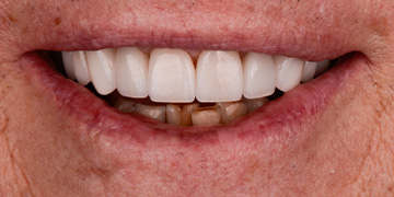Healthy flawless smile after cosmetic dentistry