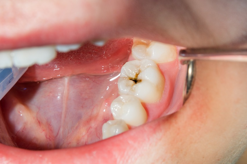 What Happens If You Don t Treat A Cavity A Dentist Explains